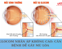 GLOCOM NHÃN ÁP KHÔNG CAO: CĂN BỆNH DỄ GÂY MÙ LÒA